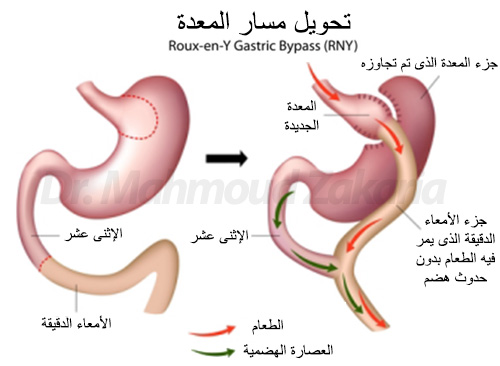 فوائد عملية تحويل مسار المعدة المصغر