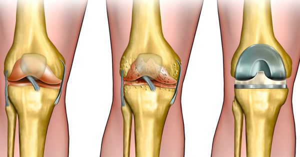 Tips for living with knee replacement