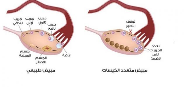 هل يمكن حصول الحمل مع وجود تكيس المبايض؟